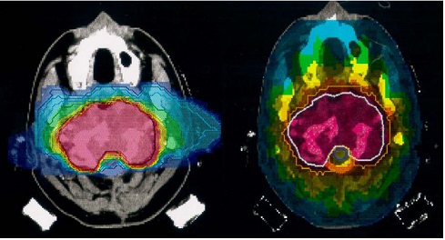 顱底腫瘤使用重粒子治療（左圖）及光子治療（右圖）之放射劑量分布圖