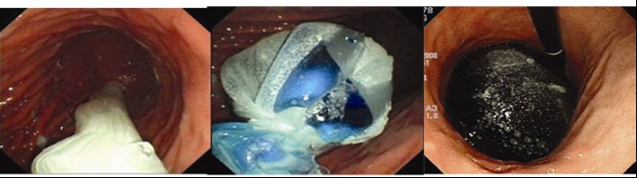 胃內水球置入術圖片