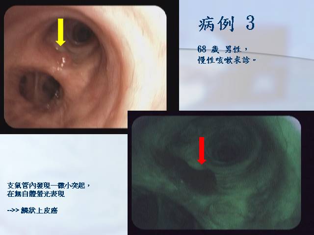 案例3為68歲男性, 因慢性咳嗽求診, 支氣管檢查時發現一顆小突起,無自體螢光表現,後來證實為肺鱗狀上皮癌