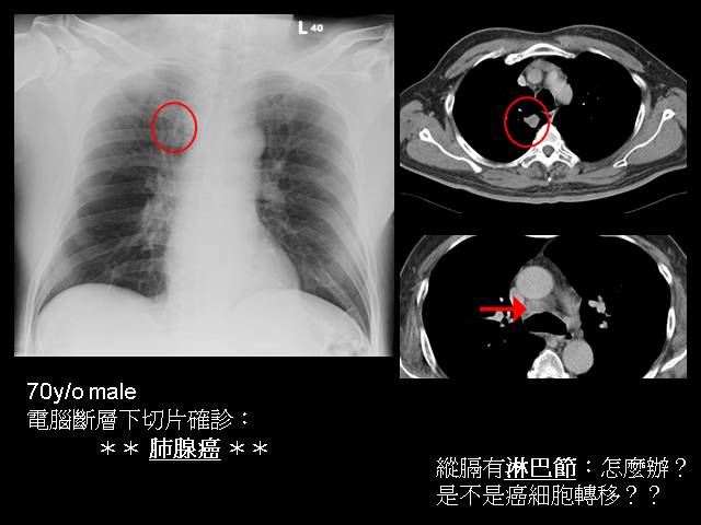 EBUS適用情境: 70歲男性,電腦斷層見到右肺有腫瘤,接受切片檢查後確認罹患肺腺癌,此時,針對縱膈腔腫大的淋巴結,應該怎麼辦呢?
