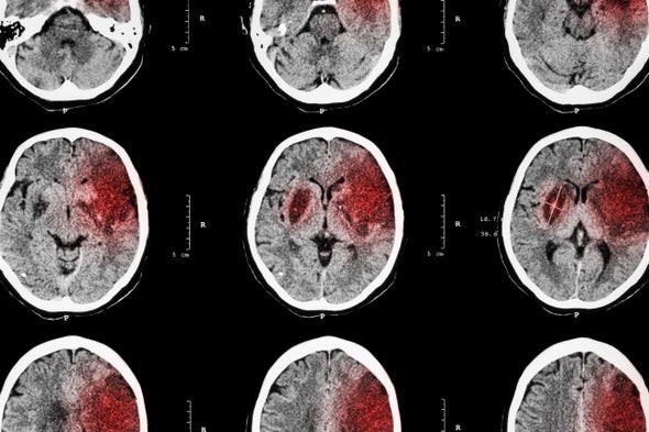 Targeting Inflammation May Protect and Restore the Brain after Stroke -  Scientific American