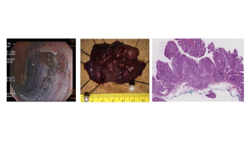 黏膜下剝離術後之大腸鏡照片，標本及病理切片