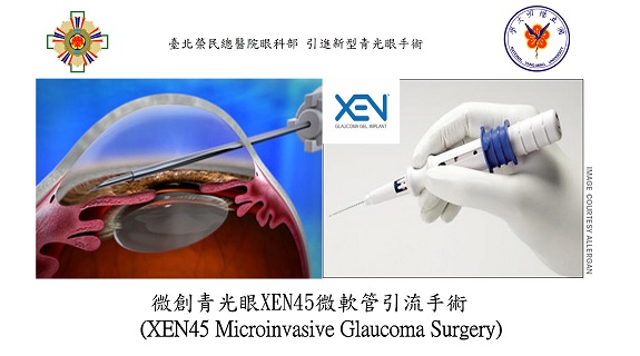 Novel Device for Glaucoma Surgery��