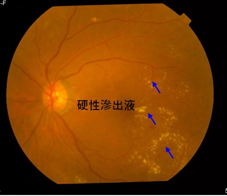 左眼基底型或非增殖型視網膜病變