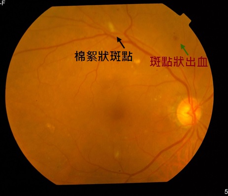 右眼基底型或非增殖型視網膜病變