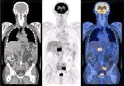 PET/CT在診療方面的應用-病人影像圖