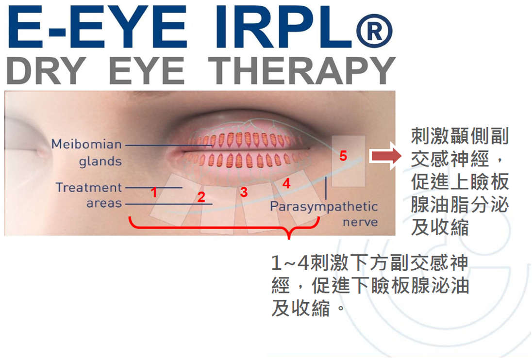 乾眼症脈衝光雷射 (IPL)